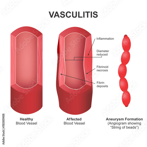 Vasculitis blood vessel cross section illustration