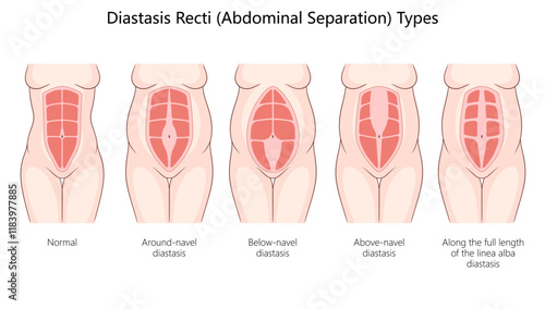 diastasis recti, including around-navel, below-navel, above-navel, and full-length abdominal separations diagram hand drawn schematic vector illustration. Medical science educational illustration