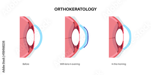 Orthokeratology contact lens
