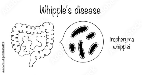 Whipple's disease