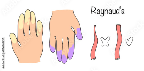 Raynaud's