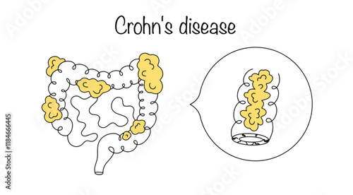 Crohn's disease