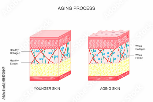 Diagram showing younger skin and aging skin.Aging process of skin.Change in collagen and elastin.Pigmented spots including age spot or liver spot may appear in sun exposed areas.