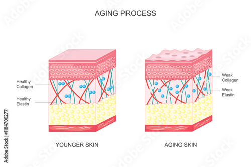 Diagram showing younger skin and aging skin.Aging process of skin.Change in collagen and elastin.Pigmented spots including age spot or liver spot may appear in sun exposed areas.