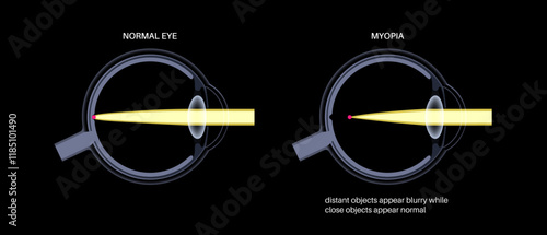 Normal eye and nearsightedness