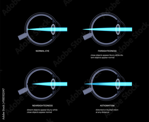 Refractive errors poster