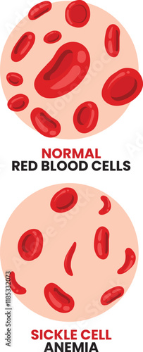 illustration of normal red blood cells vs anemia