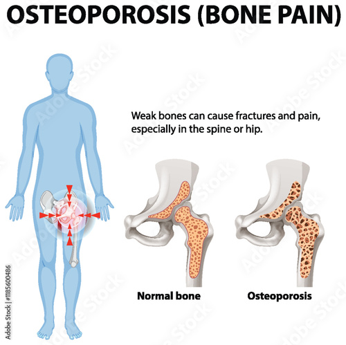 Understanding Osteoporosis and Bone Health