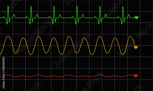 Three types of normal and abnormal heart rhythm. Vector Medical Illustration.