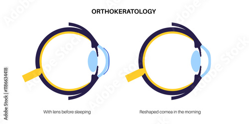 Orthokeratology contact lens