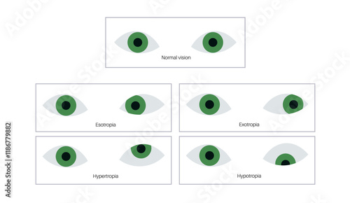 Strabismus eye disease