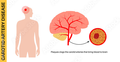 Carotid artery disease