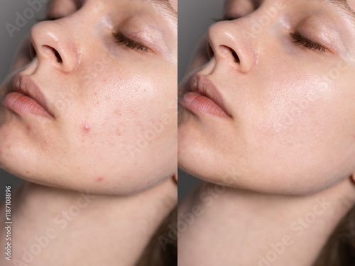  real acne close-up of a woman's face, dark spots, no make up, natural skin, problematic, before and after dermatological treatment photo