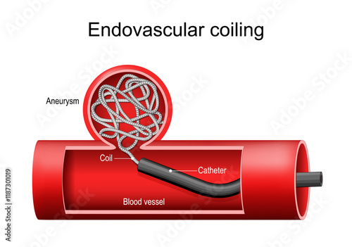 Endovascular coiling of aneurysm