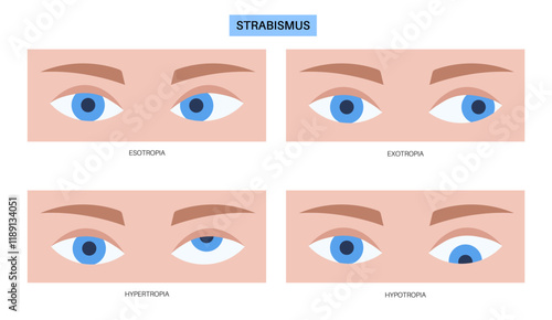Strabismus eye disease