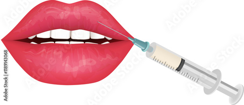 Hyaluronic acid lip augmentation filler. Cosmetic procedure that modifies the shape of the lips using fillers. Beauty Injection For Lips.