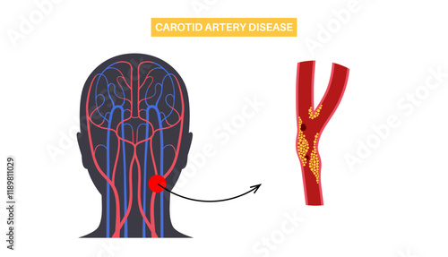 Carotid artery disease