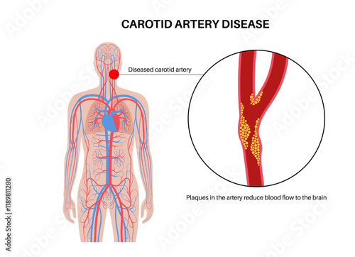 Carotid artery disease