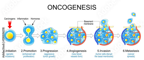 Carcinogenesis. Oncogenesis stages. Cancer development