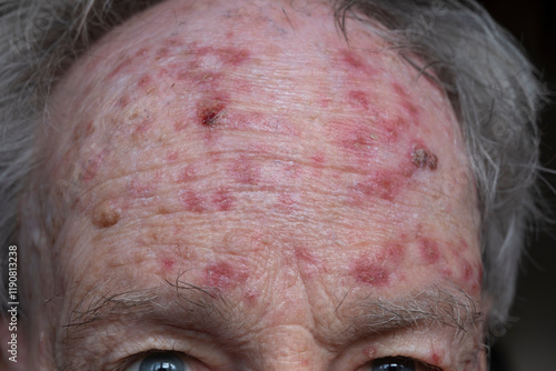 Forehead of man during treatment for actinic keratosis with Flurouracil ointment. Red crusty lesions of sun-damaged skin or sunspots