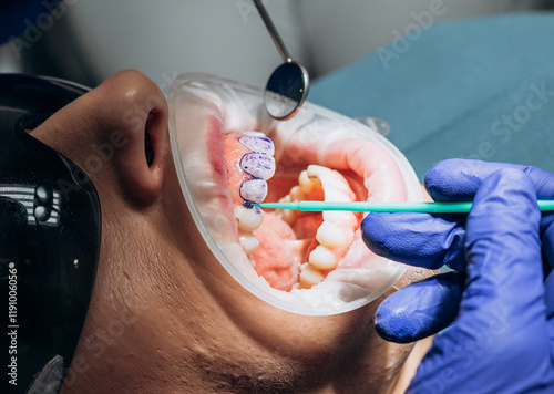 Foto Dental procedure in progress with patient wearing protective eyewear and dental