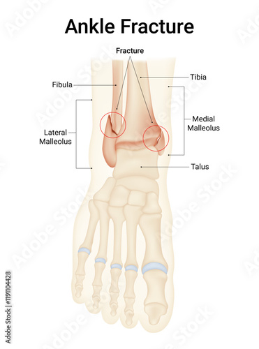 Ankle Fracture (Broken Ankle) Causes