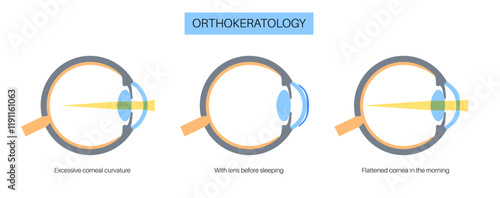 Orthokeratology contact lens