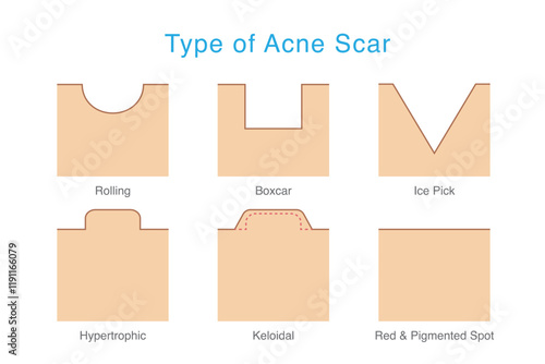 Types of acne scar on facial skin layer. Rolling, Boxed, Icepick, keloid, and hypertrophic scars isolated white background. Vector Medical diagram about skin problem from acne.