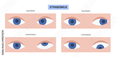 Strabismus eye disease