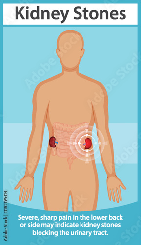 Understanding Kidney Stones and Symptoms