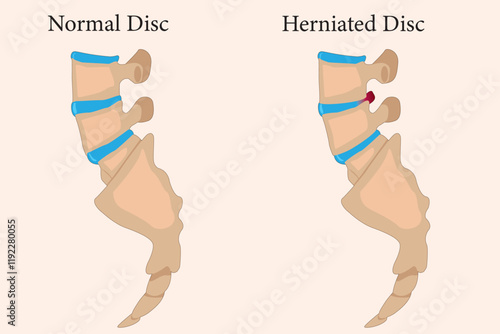 Comparing normal cervical disc and disc herniated of the patient. Illustration of Medical diagram about the problem on the spine makes pain or disability. EPS 10