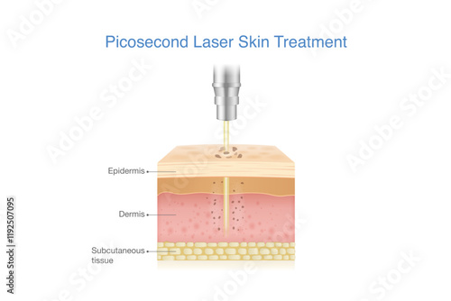 Reduce Melasma, freckles, blemishes, wrinkles and spots by Picosecond Laser breaks down pigmentation in skin layer into smaller fragments. Medical laser called Pico.