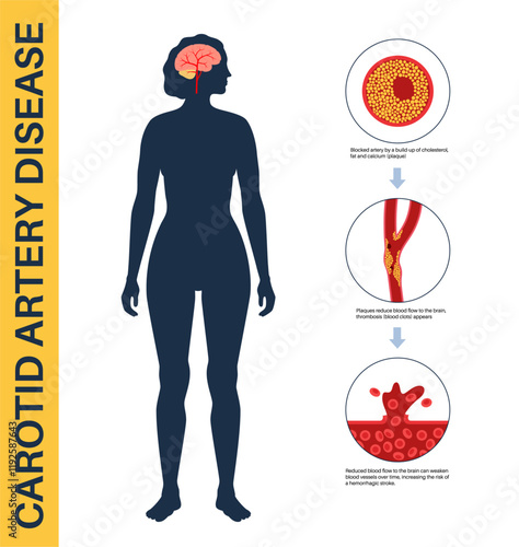 Carotid artery disease
