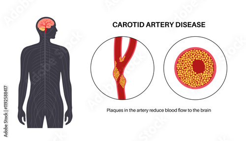Carotid artery disease