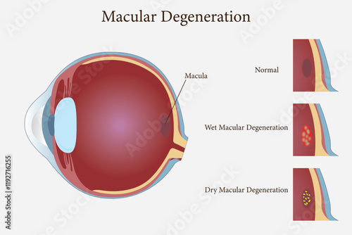 Age related macular degeneration.Eye vision disorder. vector eps 10