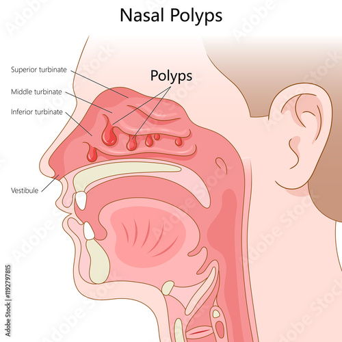 Tableau sur toile nasal polyps in the sinus cavity, labeled with turbinates and nasal anatomy for educational purposes diagram hand drawn schematic raster illustration