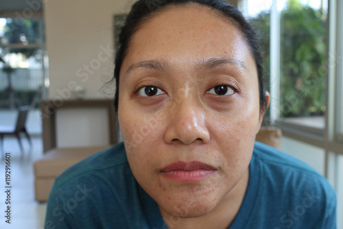 Close Up Asian woman face with acne inflamed on her face. haggard face. Under-eye bags, Tear trough deformity, Dark circles under the eyes