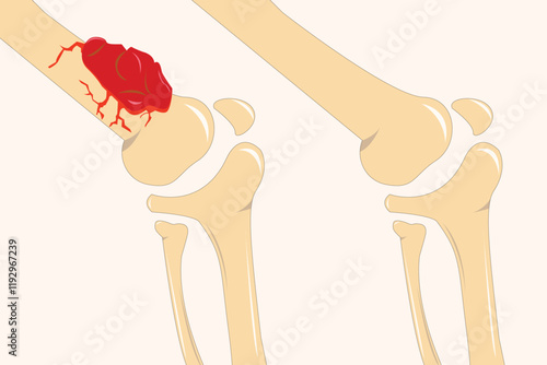 Comparison of normal bone structure and osteosarcoma-affected bone with abnormal growth. Eps 10