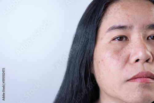 Foto Young woman's face has large pores, oily skin, combination skin, dark spots, and problem skin on the face