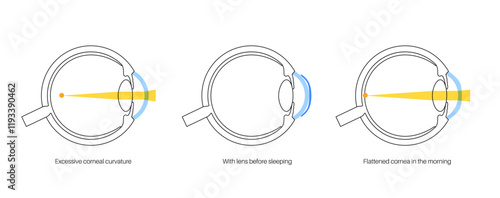 Orthokeratology contact lens