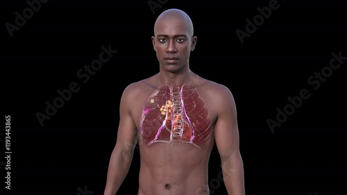 Primary lung tuberculosis in a man with the Ranke complex, 3D animation showing pulmonary lesion and mediastinal lymphadenitis with calcification. photo