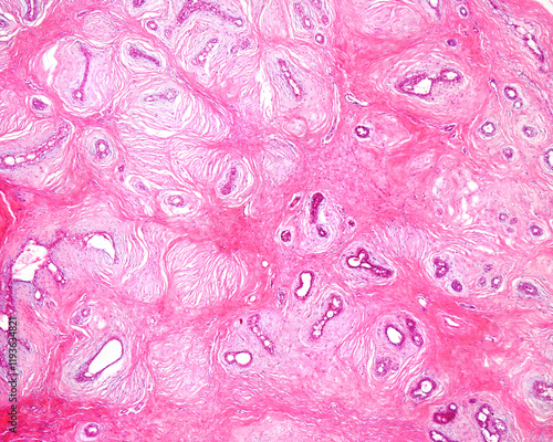 Human breast fibroadenoma photo