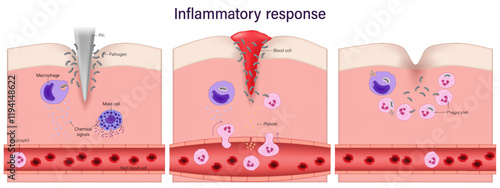 Inflammatory response. Process of inflammation. phagocytosis. Blood clotting.