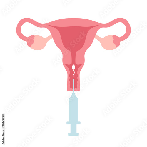 Intrauterine insemination infographic. IUI. Uterus and syringe with sperm illustration in cartoon flat style