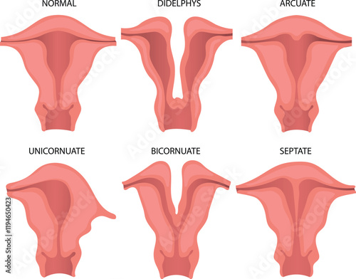 Illustration of Uterine anomalies