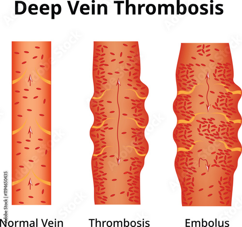 Deep Vein Thrombosis Science Design Vector Illustration Diagram