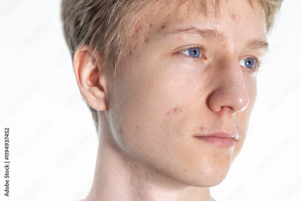 Obraz premium Close-up of Teenager's Skin with acne