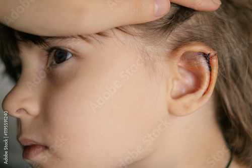 Stitches on the kid torn ear, dissection, suturing, bruise on the ear after impact and injury.  photo