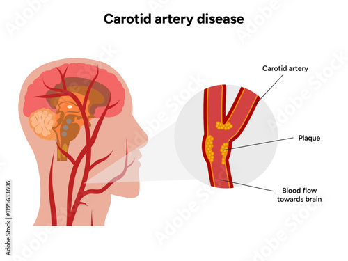 Carotid artery disease Signs of Carotid Artery Disease medical illustration diagram