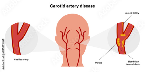 Carotid artery disease Signs of Carotid Artery Disease medical illustration diagram
